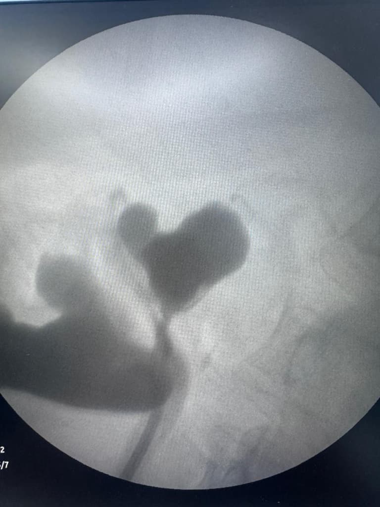 Fluoroscopic imaging during urological procedure