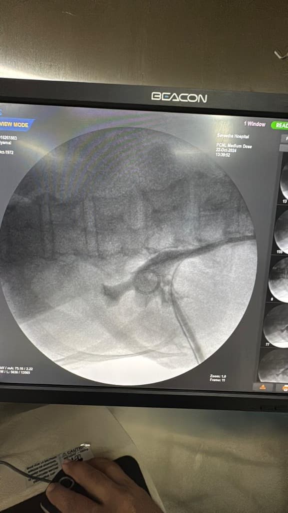 PCNL procedure fluoroscopic view
